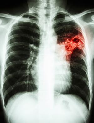 Poussières toxiques de bois - poumons